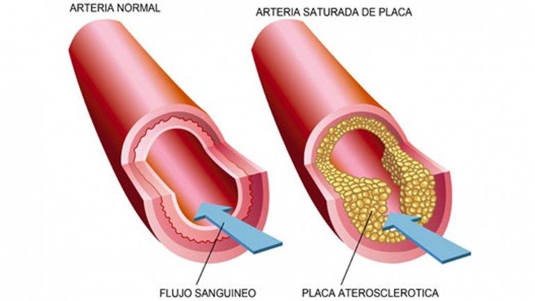 colesterol-alto