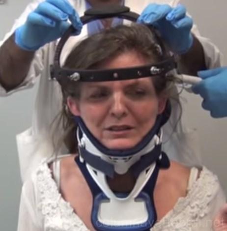 La órtesis cervical es un aparato externo que ayuda a inmovilizar la primera región de la columna vertebral.