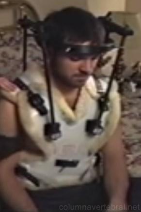 La órtesis de halo se utiliza para corregir la columna vertebral