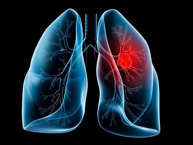 Tratamiento del cáncer de pulmón