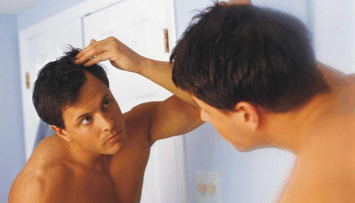 Alopecia por esteroides