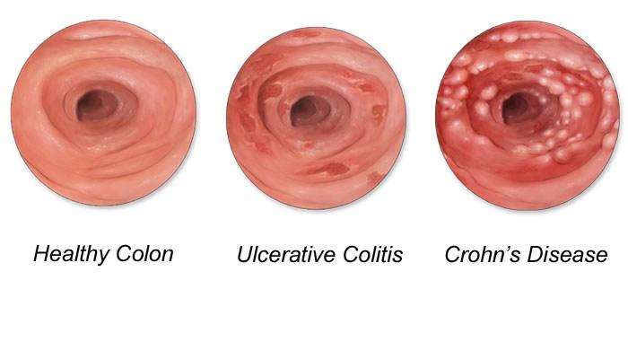 Crohn, colon inflamado