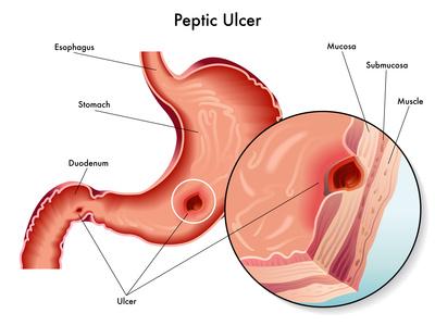 úlcera péptica 02