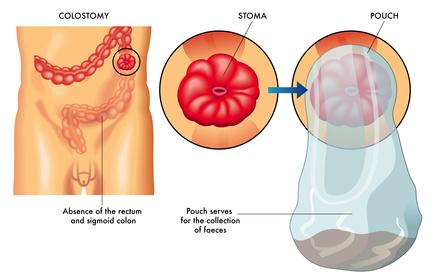 Colostomía - estoma - bolsa de colostomía