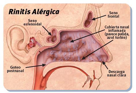 Rinitis Alérgica