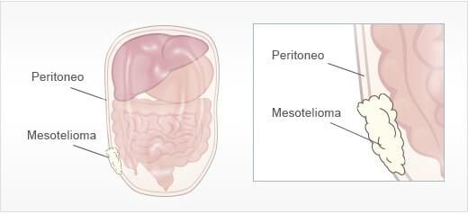 mesotelioma peritoneal