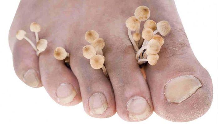 los hongos y las uñas