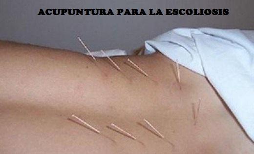 La acupuntura para la escoliosis es usada en todo el mundo
