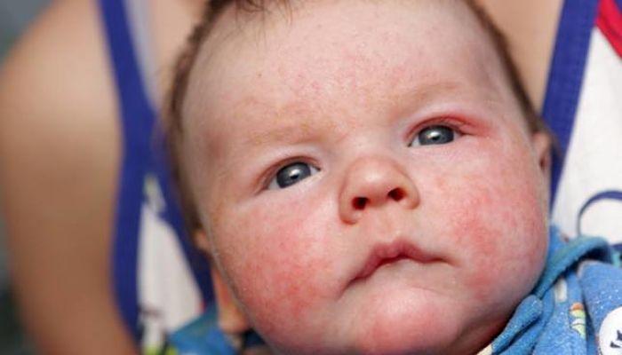 piel atopica en bebés