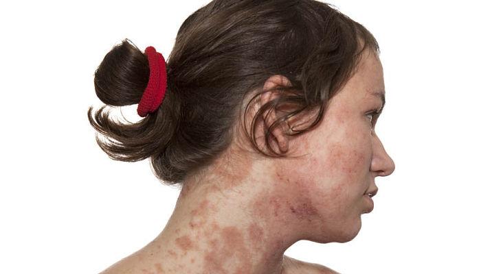 que es una piel atopica