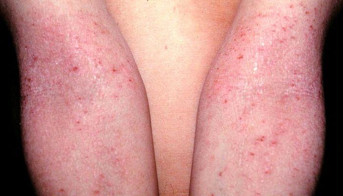 piel atopica irritada