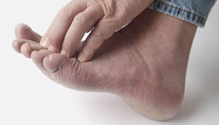 sabañones en los pies tratamiento