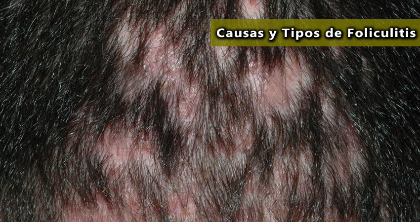 Causas y tipos de foliculitis
