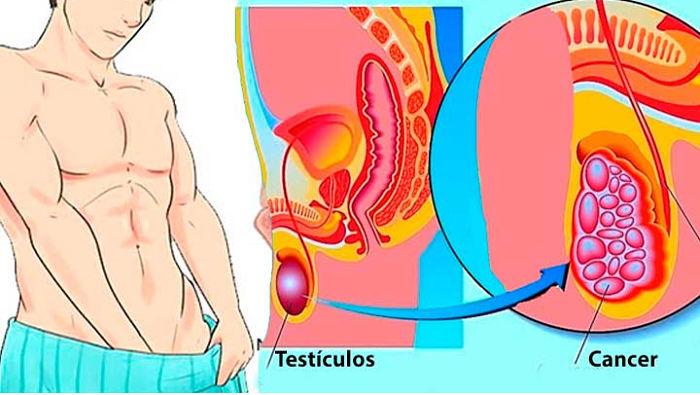 tipos de cancer en hombres
