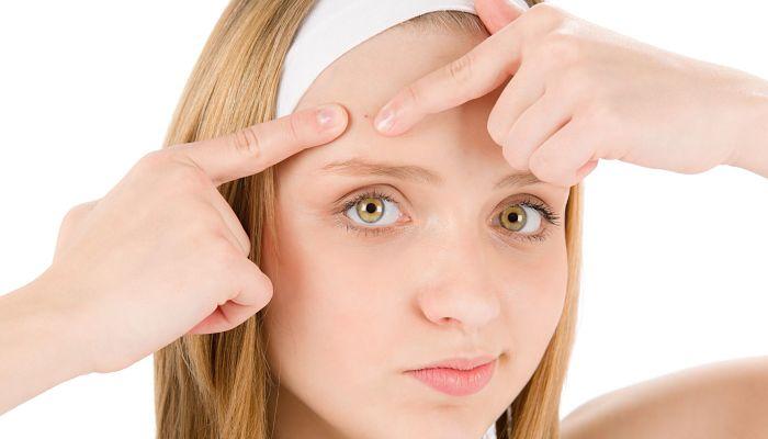 vinagre de sidra de manzana combate el acné