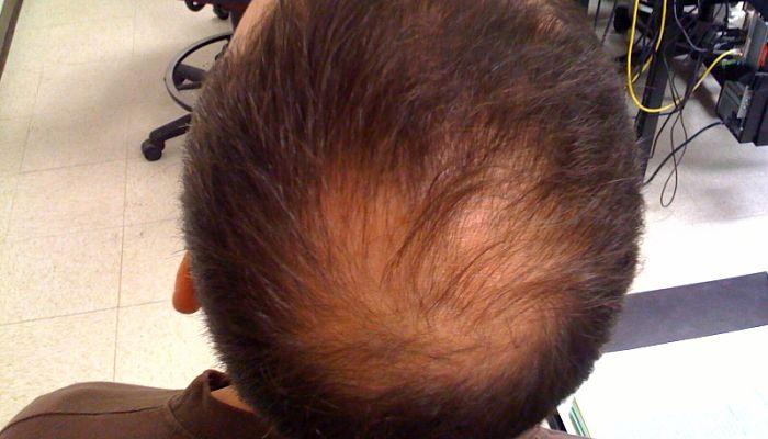 alopecia