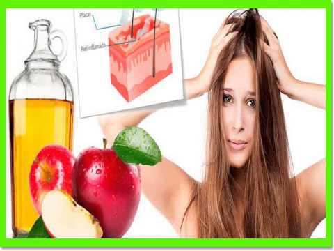 Remedios para la caspa