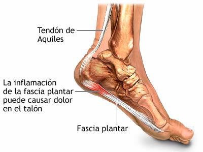 Causas fascitis plantar