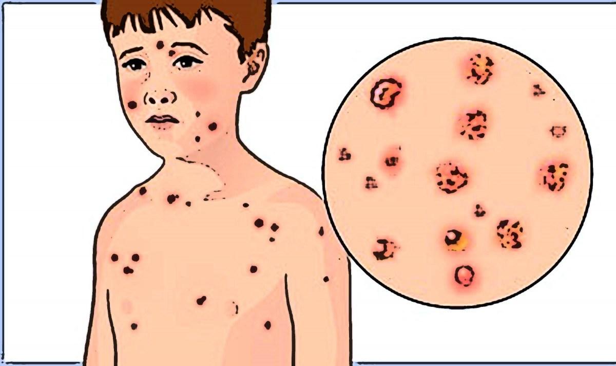 remedios caseros contra la varicela