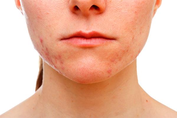 marcas de acne