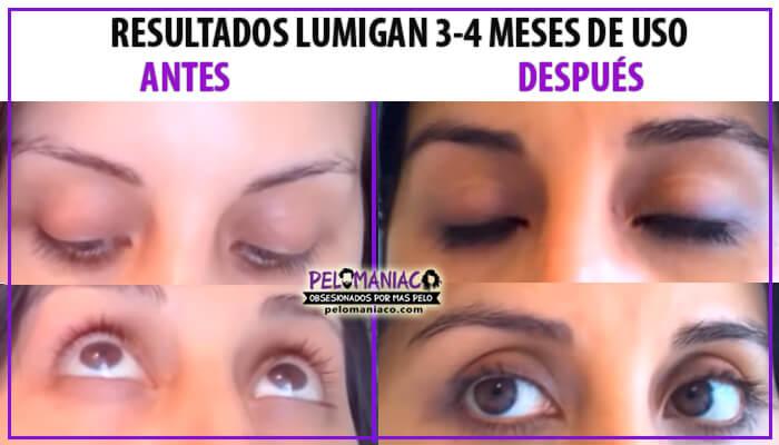 Lumigan pestañas Bimatoprost resultados antes y despues
