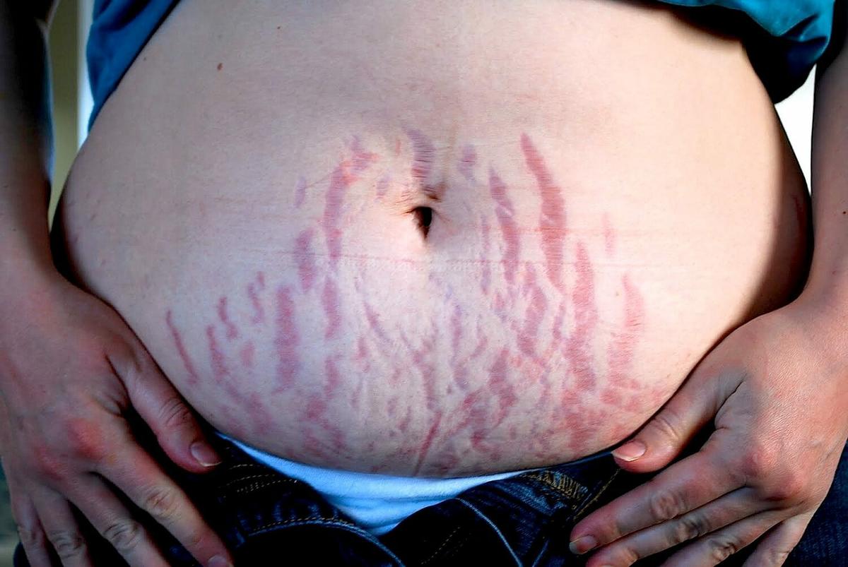 Remedios caseros para las estrías