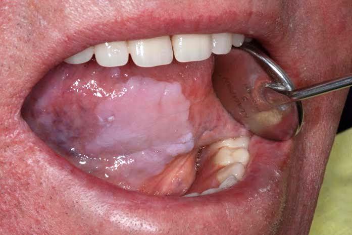 cancer oral