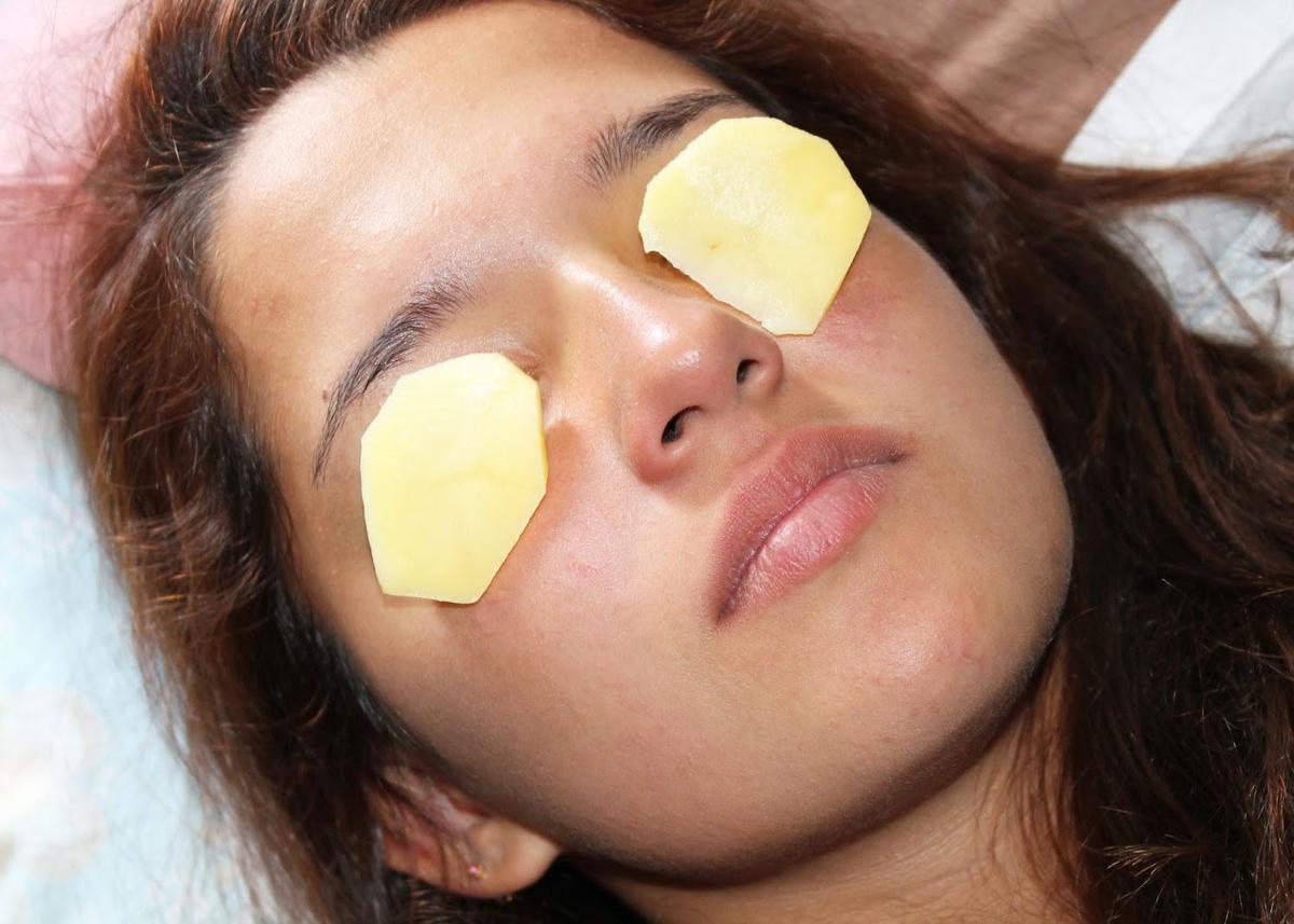 Papas para reducir hinchazón en los ojos