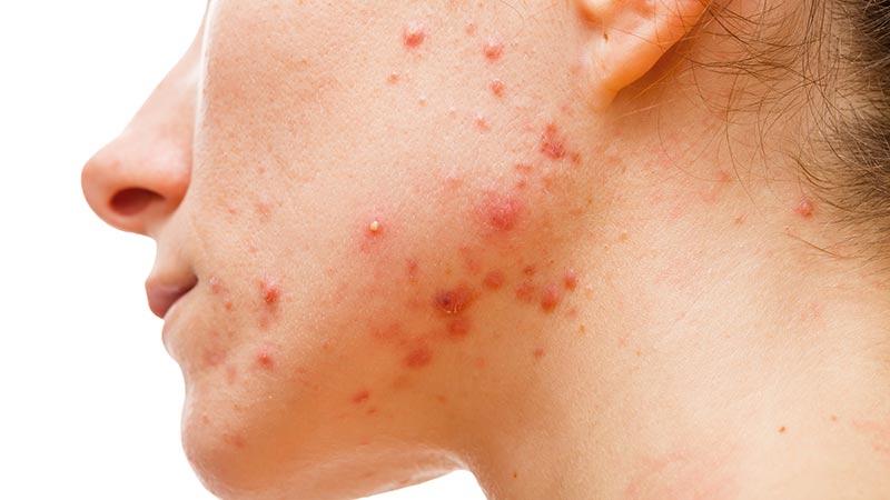 alimentos-acne