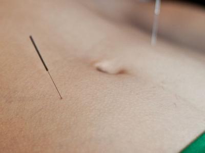 la acupuntura es un remedio para la menopausia