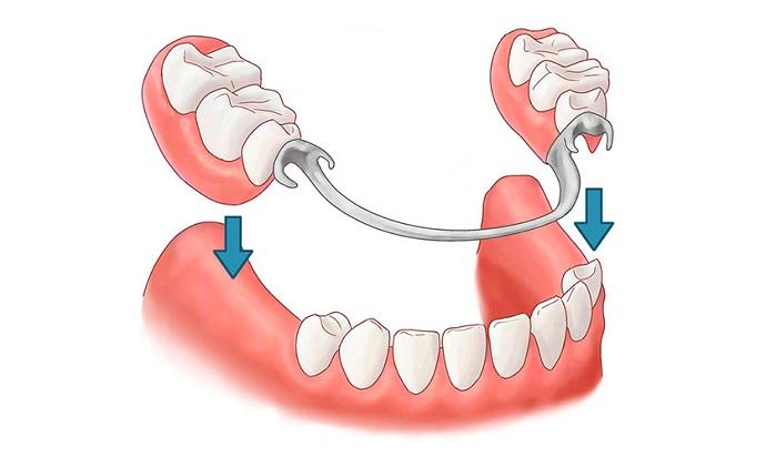 protesis dental clinica dental bonadent