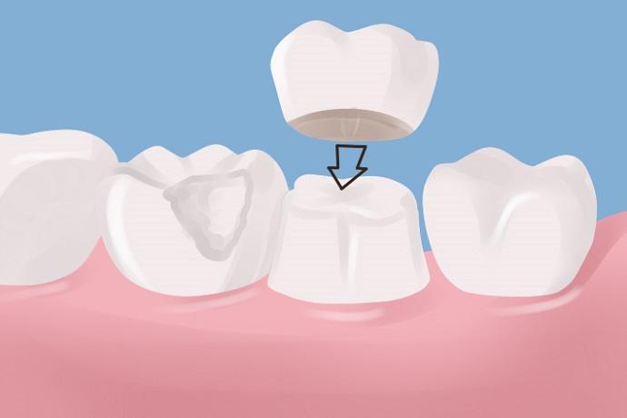 protesis dental madrid clinica dental bonadent coronas dentales madrid