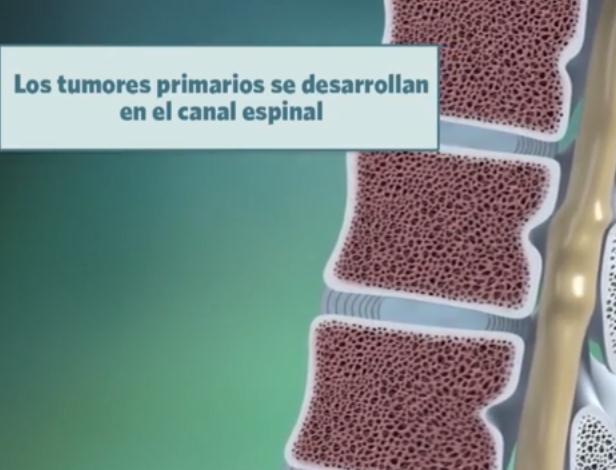 cáncer de columna vertebral primario