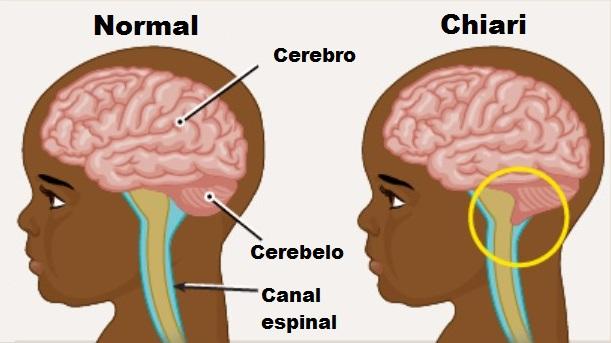 La malformación de Chiari fue clasificada por orden de severidad