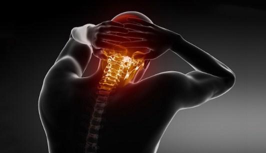 Los sintomas de la malformación de Chiari están relacionados con la formación de una siringe