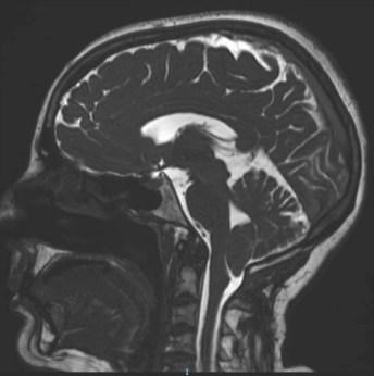 Para diagnosticar la malformación de Chiari existen varias pruebas