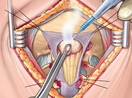 El tratamiento de la malformación de Chiari depende del tipo exacto de malformación