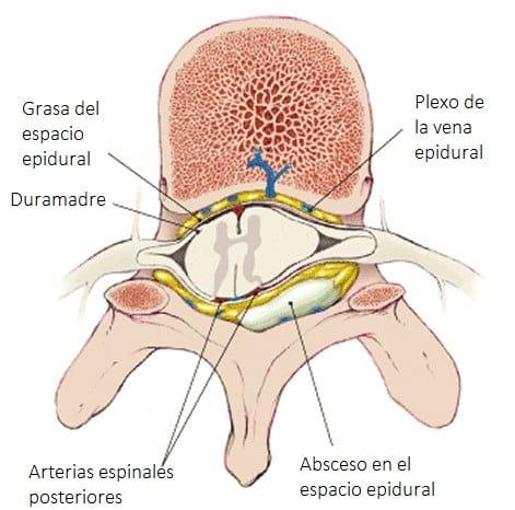 los abscesos epidurales espinales aparecen en las regiones torácicas o lumbares