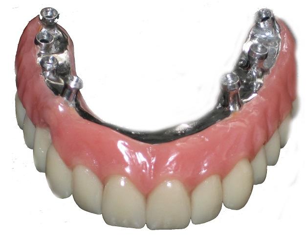 protesis-dental-sobre-implantes-clinica-dental-aviles-centro-dental-innova