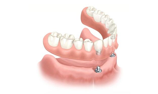 protesis-dental-sobre-implantes-clinica-dental-aviles-centro-dental-innova