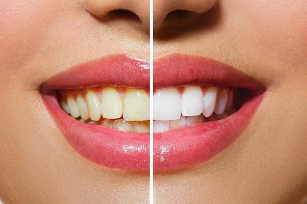 blanqueamiento dental-clinica dental aviles-centro dental innova