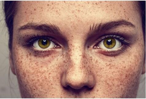 Consejos para combatir las manchas en la piel
