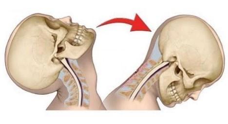 El mareo cervical es el resultado de una lesión en la cabeza