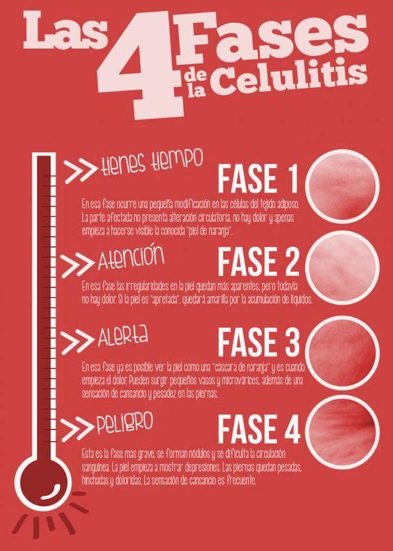 Fases de la celulitis.