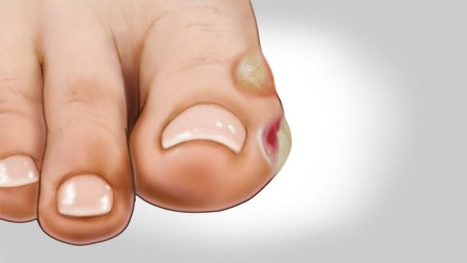 ampolla en los pies
