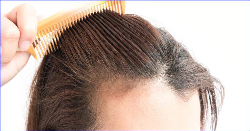 alopecia femenina por estres, alopecia femenina soluciones, alopecia femenina a que se debe