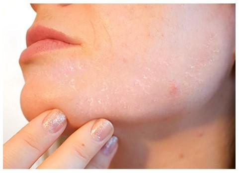 Cómo Evitar Tener una Piel Escamosa