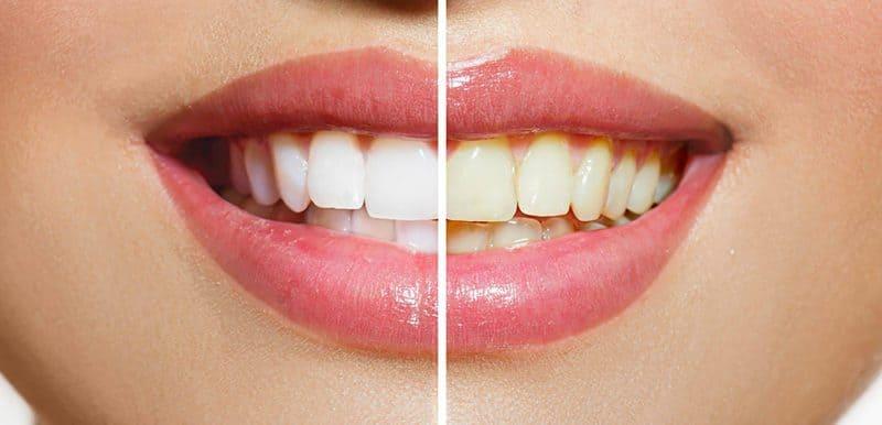 como blanquear los dientes en casa