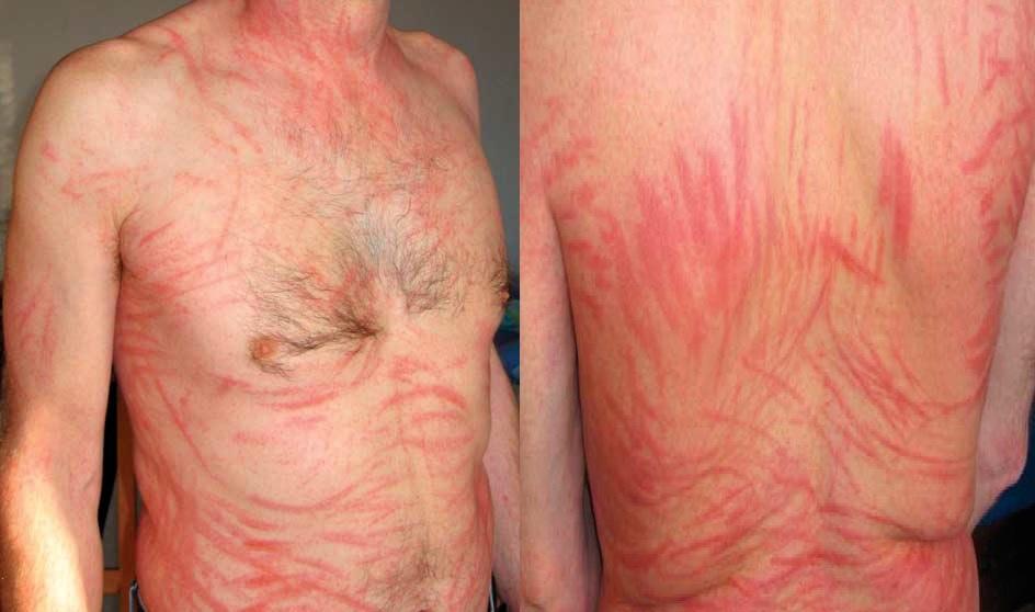 Erupciones eritimatosas lineales. Crédito LÓPEZ & col., 2012.