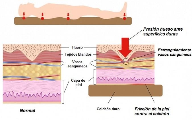 formacion escaras en piel
